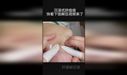 挤粉刺视频,告别痘痘困扰！